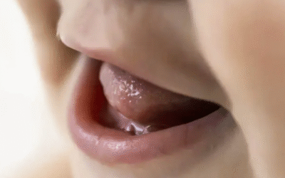 ¿Qué son las Perlas de Epstein en bebés? Lo que debes saber